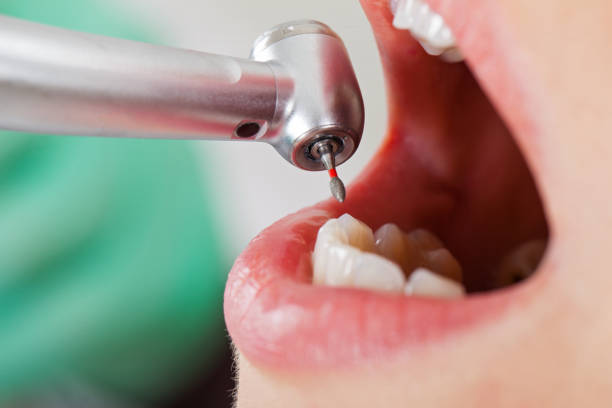 Best Broken or Chipped Tooth Repair in Slatington, PA